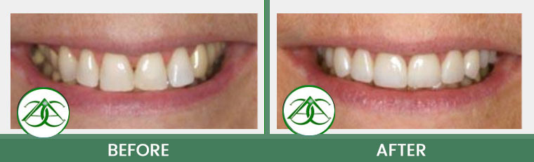 Crowns (Caps) at ABC Dental Center in Mountain View, CA