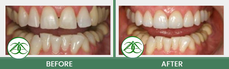 Crowns (Caps) at ABC Dental Center in Mountain View, CA