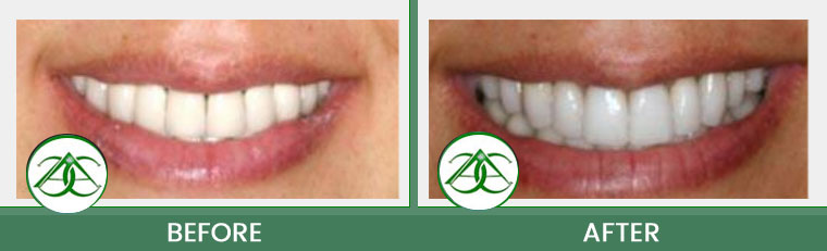 Porcelain Crowns (Caps) at ABC Dental Center in Mountain View, CA
