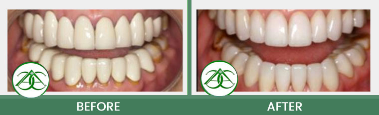 Porcelain Crowns (Caps) at ABC Dental Center in Mountain View, CA