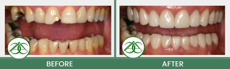 Porcelain Crowns (Caps) at ABC Dental Center in Mountain View, CA