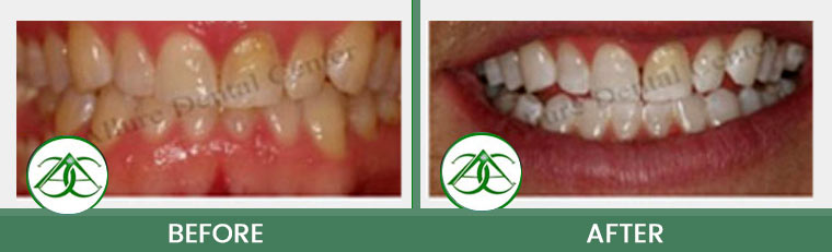 Deep Bleaching/Whitening at ABC Dental Center in Mountain View, CA