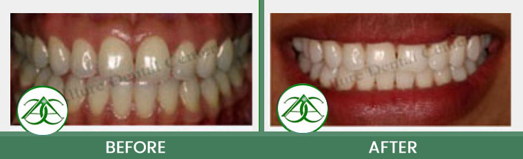 Deep Bleaching/Whitening at ABC Dental Center in Mountain View, CA
