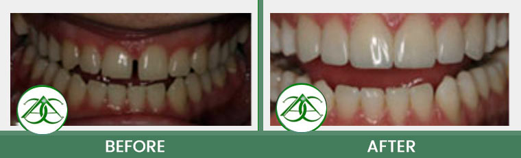 Dental Bonding at ABC Dental Center in Mountain View, CA