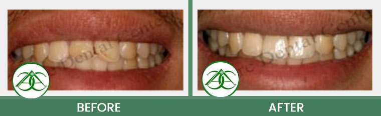 Dental Bonding at ABC Dental Center in Mountain View, CA