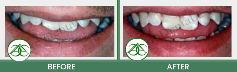 Dental Bonding at ABC Dental Center in Mountain View, CA