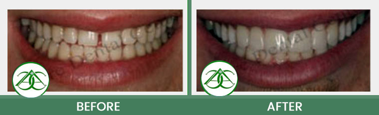 Dental Bonding at ABC Dental Center in Mountain View, CA