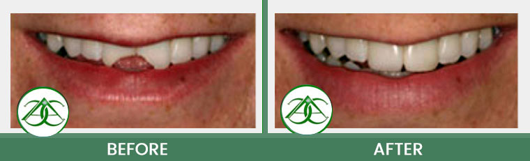 Dental Bonding at ABC Dental Center in Mountain View, CA