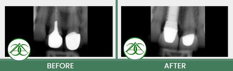 Dental Implants at ABC Dental Center in Mountain View, CA