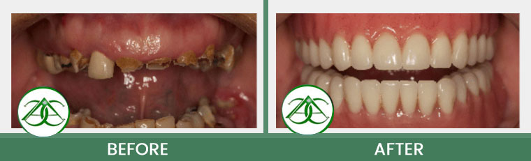 Dental Implants at ABC Dental Center in Mountain View, CA