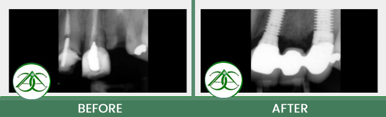 Dental Implants at ABC Dental Center in Mountain View, CA