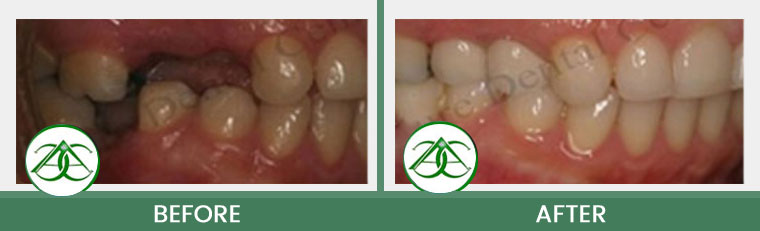 Dental Implants at ABC Dental Center in Mountain View, CA