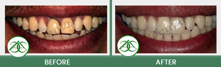 Dental Implants at ABC Dental Center in Mountain View, CA