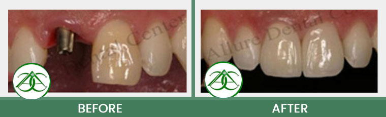 Dental Implants at ABC Dental Center in Mountain View, CA