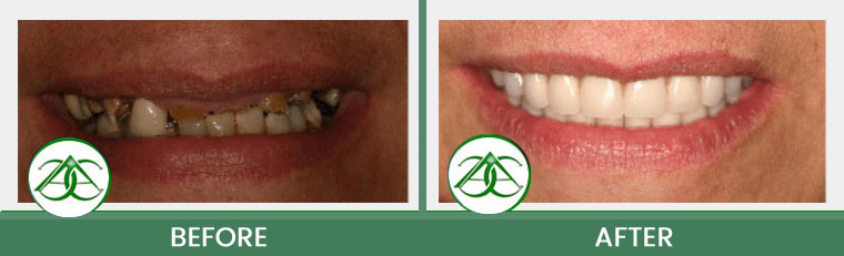 Dental Implants at ABC Dental Center in Mountain View, CA