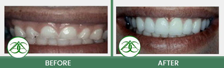 Gum Lifts/Contour at ABC Dental Center in Mountain View, CA