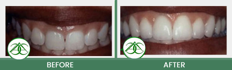 Gum Lifts/Contour at ABC Dental Center in Mountain View, CA