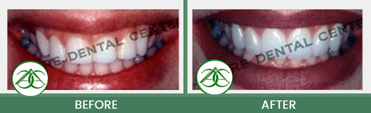 Gum Lifts/Contour at ABC Dental Center in Mountain View, CA