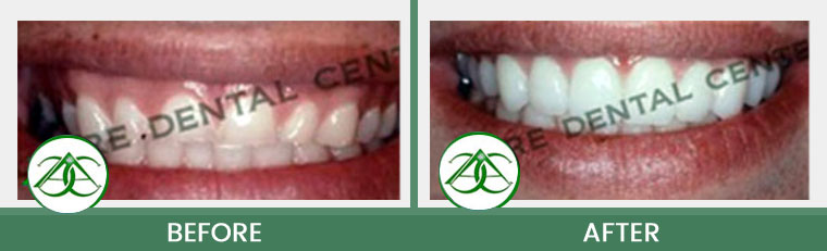 Gum Lifts/Contour at ABC Dental Center in Mountain View, CA
