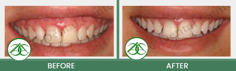 Gum Lifts/Contour at ABC Dental Center in Mountain View, CA