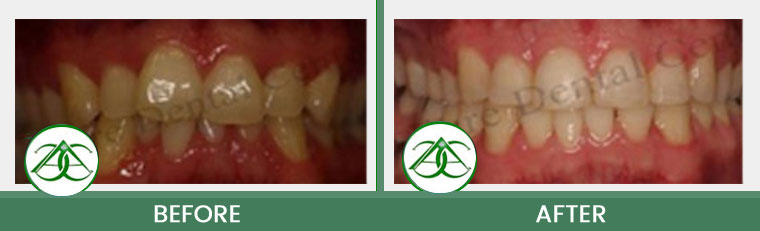 Orthodontics/Invisalign at ABC Dental Center in Mountain View, CA