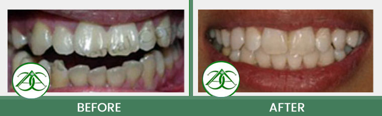 Orthodontics/Invisalign at ABC Dental Center in Mountain View, CA