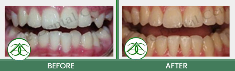 Orthodontics/Invisalign at ABC Dental Center in Mountain View, CA