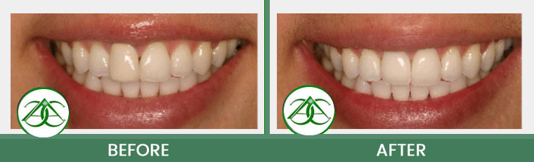 Porcelain Crowns (Caps) at ABC Dental Center in Mountain View, CA