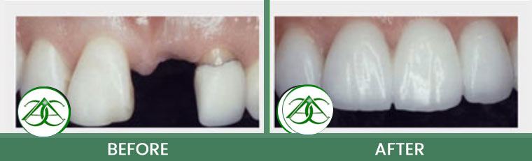 Porcelain Fixed Bridges at ABC Dental Center in Mountain View, CA