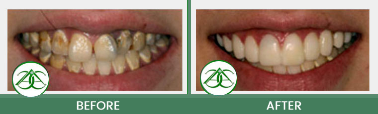 Porcelain Veneers at ABC Dental Center in Mountain View, CA