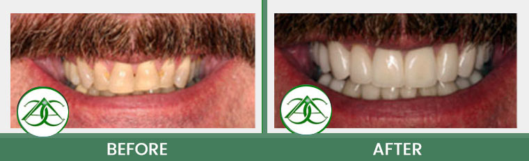 Porcelain Veneers at ABC Dental Center in Mountain View, CA