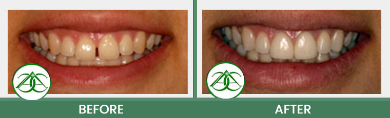 Porcelain Veneers at ABC Dental Center in Mountain View, CA