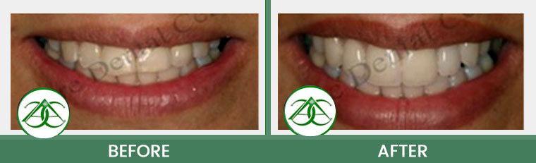 Porcelain Veneers at ABC Dental Center in Mountain View, CA