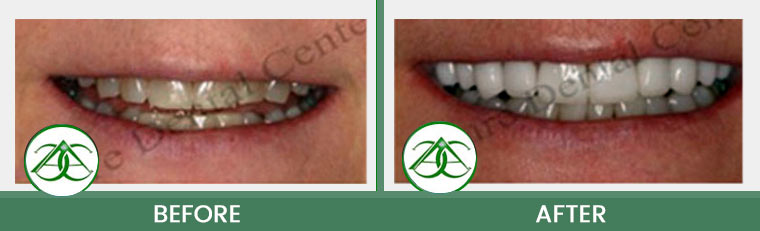 Porcelain Veneers at ABC Dental Center in Mountain View, CA