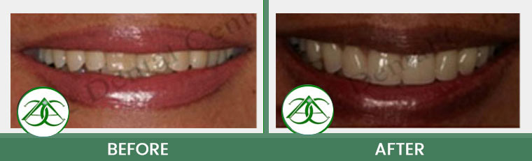Porcelain Veneers at ABC Dental Center in Mountain View, CA