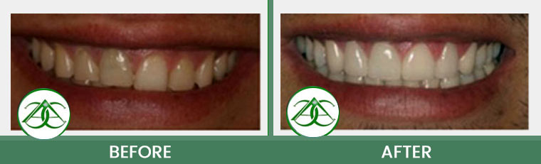 Porcelain Veneers at ABC Dental Center in Mountain View, CA