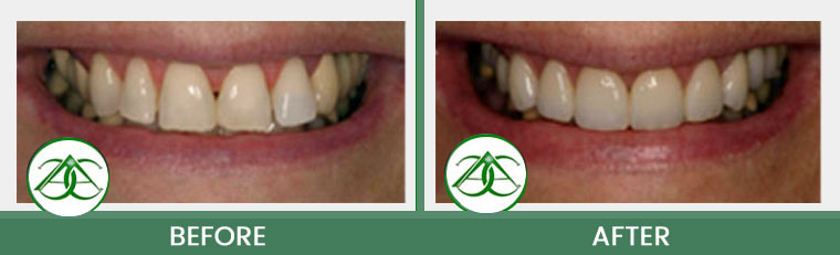Porcelain Veneers at ABC Dental Center in Mountain View, CA