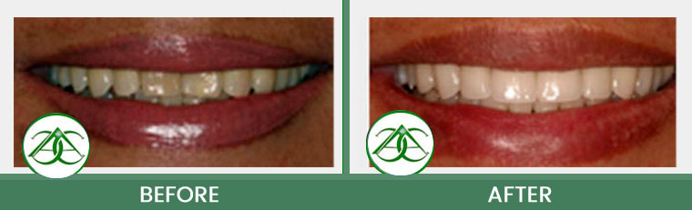 Porcelain Veneers at ABC Dental Center in Mountain View, CA
