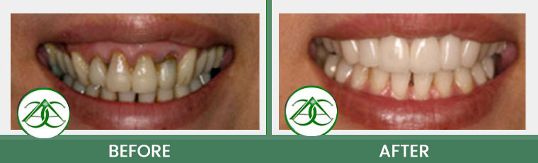 Porcelain Veneers at ABC Dental Center in Mountain View, CA