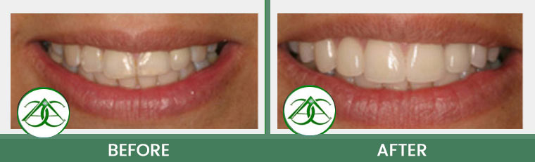 Porcelain Veneers at ABC Dental Center in Mountain View, CA
