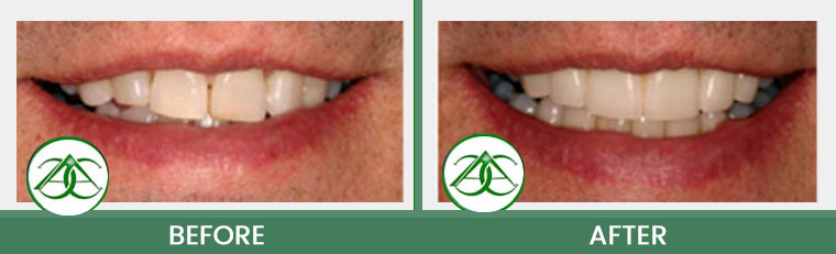 Porcelain Veneers at ABC Dental Center in Mountain View, CA