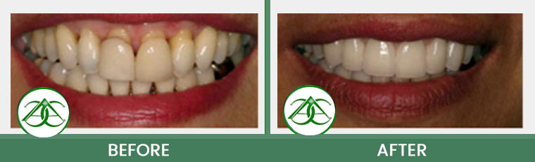 Porcelain Veneers at ABC Dental Center in Mountain View, CA