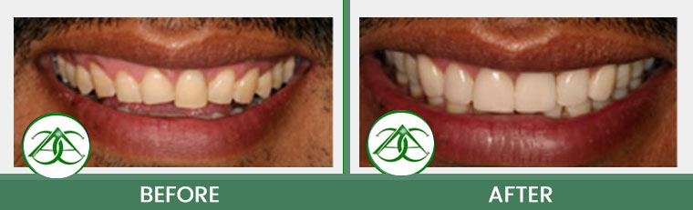 Porcelain Veneers at ABC Dental Center in Mountain View, CA
