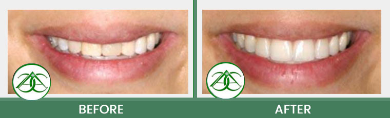 Porcelain Veneers at ABC Dental Center in Mountain View, CA