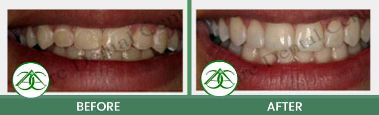 Smile Makeover at ABC Dental Center in Mountain View, CA