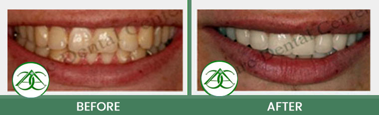 Smile Makeover at ABC Dental Center in Mountain View, CA