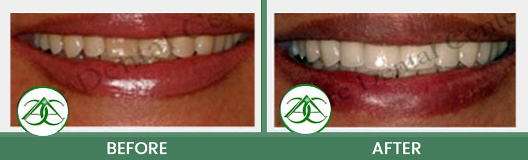 Smile Makeover at ABC Dental Center in Mountain View, CA