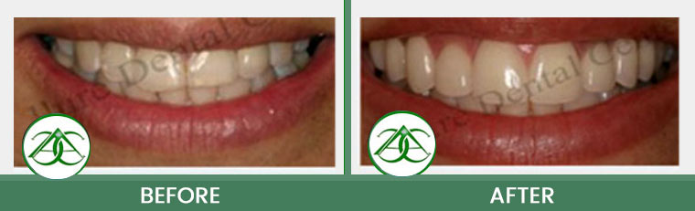 Smile Makeover at ABC Dental Center in Mountain View, CA