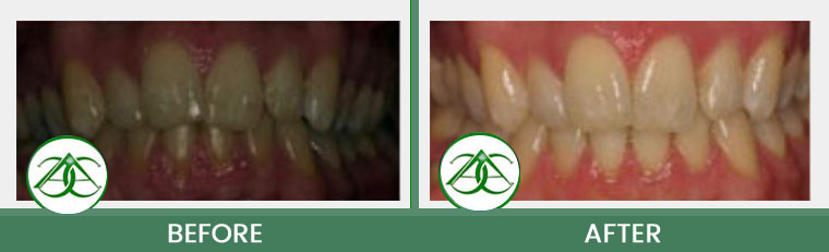 Tissue Graft at ABC Dental Center in Mountain View, CA