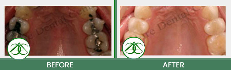 Tooth-Colored Fillings (Anterior and Posterior) at ABC Dental Center in Mountain View, CA